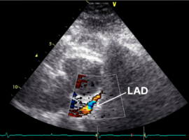 Diagnostics of Significant Coronary Artery Stenosis in Asymptomatic Patients Based on Transthoracic Echocardiography Data