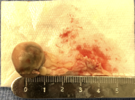 From Persistent Bacteremia to Pulmonary Valvectomy: A Multidisciplinary Approach to Isolated Pulmonary Valve Endocarditis