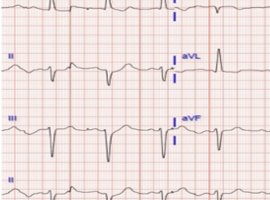 A Shifting Cardiomyopathy: Transition Between Stress and Apical Variant Hypertrophic Cardiomyopathy: A Case Report
