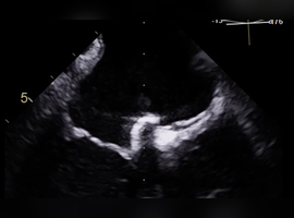Porcelain Left Atrium in a Patient Being Evaluated for Percutaneous Closure of a Patent Foramen Ovale