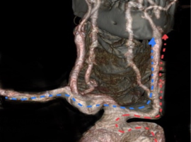 Urgent Carotid Angioplasty via the Ulnar Artery in Bovine Arch Anatomy: A Case Report