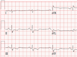 Treatment of Ventricular Tachycardia Storm with Transvenous Overdrive Pacing in a Patient with a Normal QT Interval
