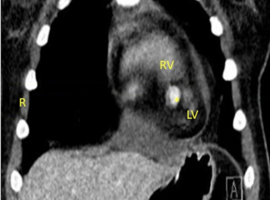 A Rare Cause of Chest Pain and Pericardial Effusion